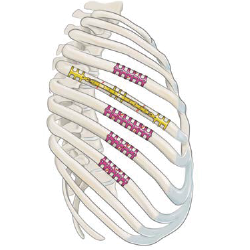 Rib clips with titanium connecting bar
