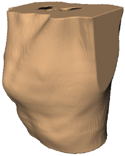 Pectus Carinatum Computer Model 3D