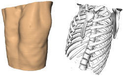 Pectus Excavatum Computer Model 3D