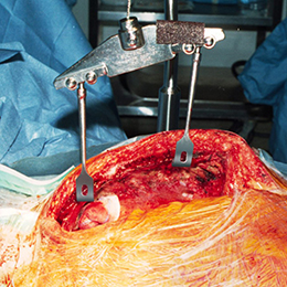 Rultract IMA dissection