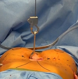 Pectus elevation surgery