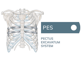 MedXpert PES Pectus Excavatum Repair